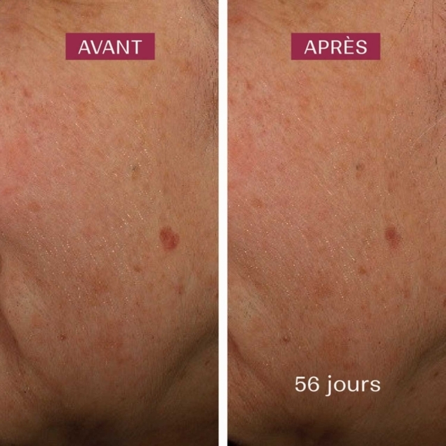 Siero Anti Macchie Azione Anti Ricomparsa